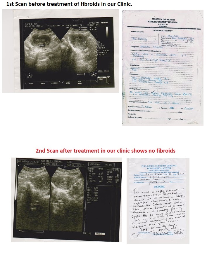 FIBROIDS TESTIONY PT KIRUI