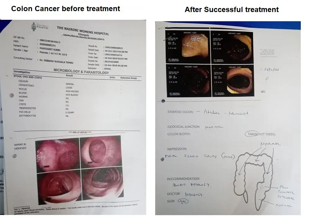 Best natural herbal cancer treatment